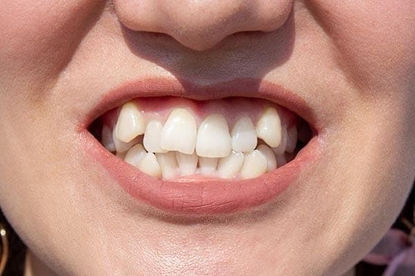 Crooked Teeth treatment and symptom relief at M S Dental Nest Bengaluru