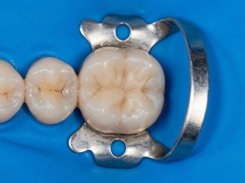 Fillings procedure at M S Dental Nest - Dental clinic near Forum Mall South Bengaluru